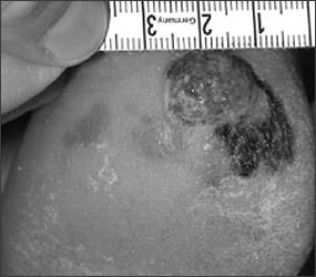 Main Types of Melanoma in the U.S. Acral lentiginous melanoma 5% Most common in dark-skinned people Image source: www.aafp.