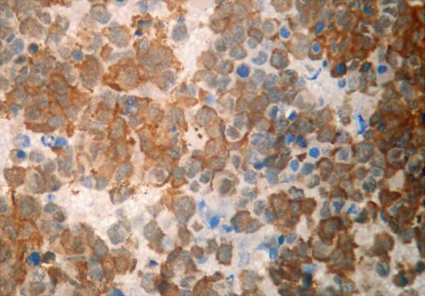 c d Fig 7: a) Case of small cell carcinoma in smear. Papanicolaou x00. b) Corresponding cell-block. H&E x 400. c) IHC for Chromogranin in the cell-block x400. d) IHC for NSE in cell-block, x00.