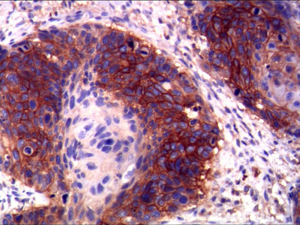 ADAM17 expression in esophageal cancer cells was located in the cytoplasm in which brown granules appeared, positive (+ + +), SP 100X.
