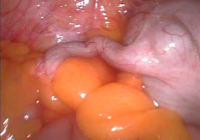 Diagnosis of Cancer A diagnosis of cancer in the appendix usually does not occur until the tumor has reached stage IV and the gland has ruptured.