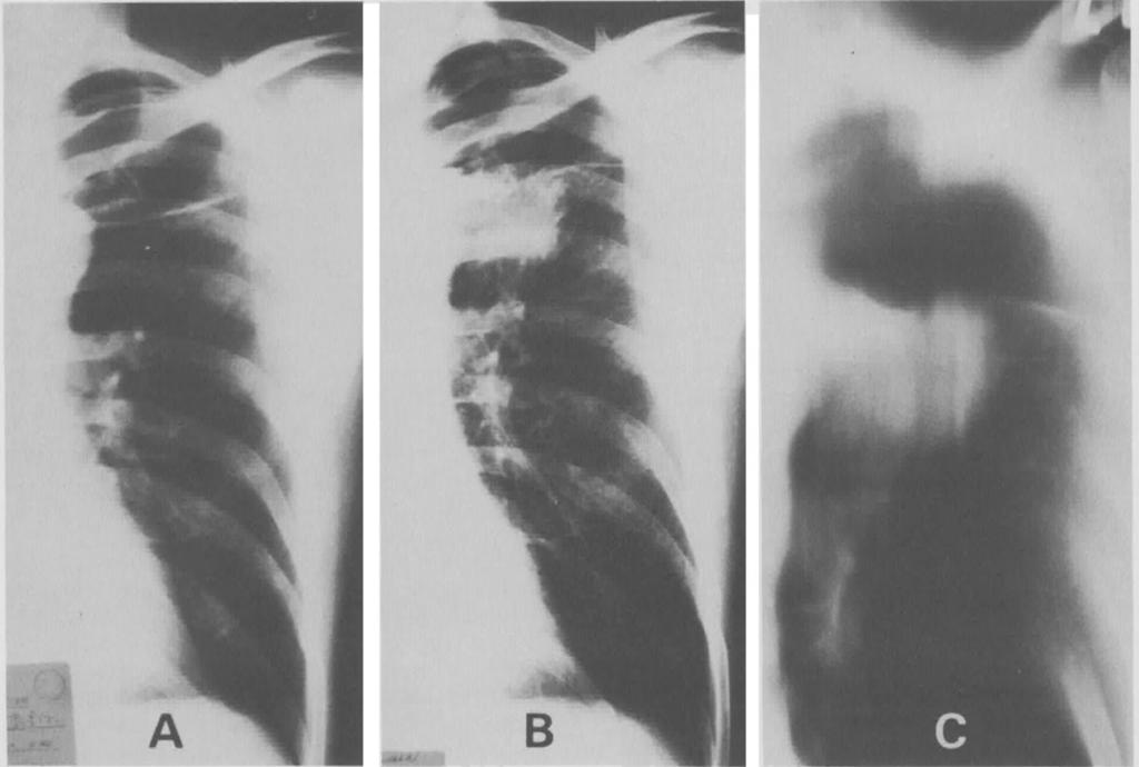 Fig 1. Chest roentgenograms of a 59-year-old man reveal (A) a large bulla of the left upper lobe in 1977, and (B) in October, 1983, an obvious nodular opacity adjoining the bulla.