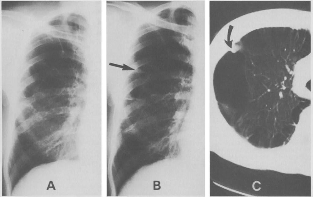 Chest roentgenograms of a 56-year-old man show (A) large, air-containing cystic spaces in the right lung in 1985, and (B) on August 27, 1987, a small nodular opacity (arrow), 0.
