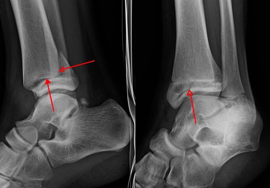 Foot and Ankle LisFranc Injury Triplane fracture High ankle sprain Deltoid injury Achilles