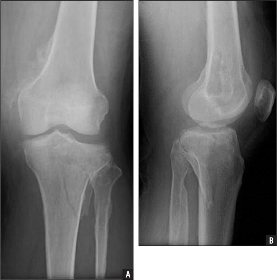 Knee Locked knee Postero-lateral corner Extensor