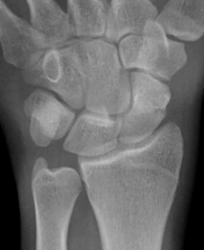 Hand and Wrist Scaphoid fracture
