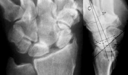 Scapho-lunate injuries Perilunate dislocation