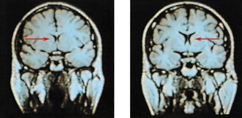MRI: magnetic resonance imaging fmri: functional MRI MRI (magnetic resonance imaging) makes images from signals produced by brain tissue after magnets align the spin of atoms.