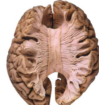 Split- Brain Studies To end severe whole-brain seizures,