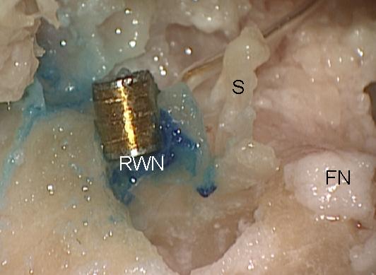 Fig. 4. Temporal bone preparation (fresh temporal bone specimen) with the round window niche (RWN) exposed to the extent of approximately 2.5 x 2.5 mm and inserted FMT.