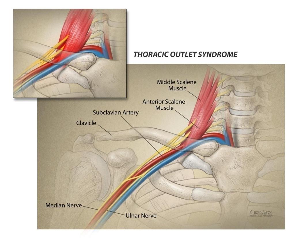 Thoracic Outlet Syndrome Constellation of signs and symptoms caused by compression of the