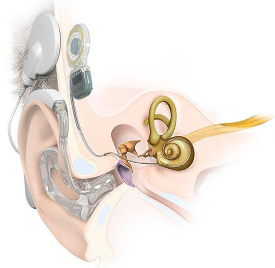 Combined electric and acoustic hearing (Shorter) cochlear implant for high frequencies Hearing aid with residual hearing for low frequencies MEDEL An