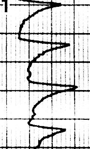 Only A) is purely pendular, all others have some amount of jerk component. Horizontal bars indicate 0.5 seconds, vertical bars indicate 1 degree. Foveation periods are at the bottom of each trace.
