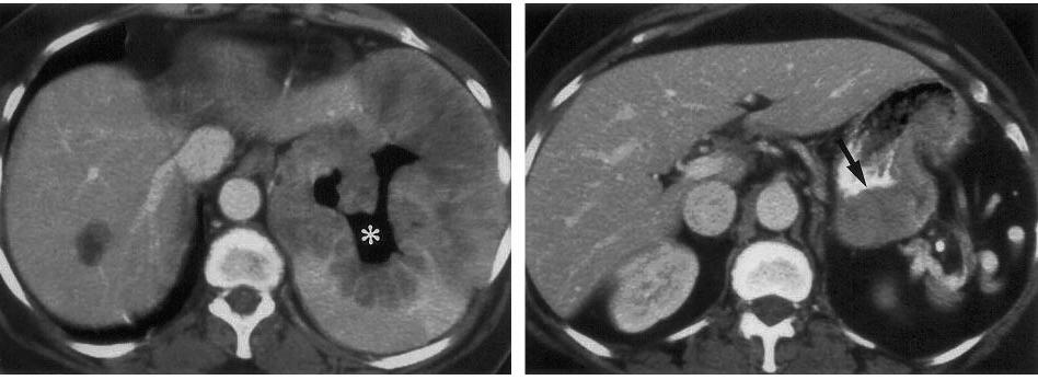 Imaging of stomoch GIST CT Subdiaphragmatic cavitary mass of