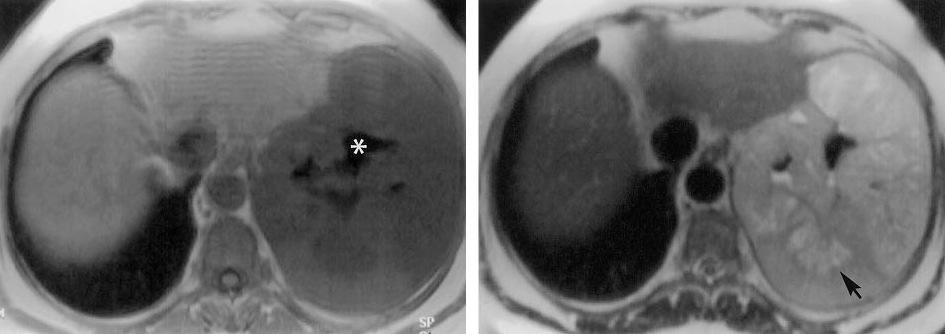 Imaging of stomoch GIST MRI Focal high