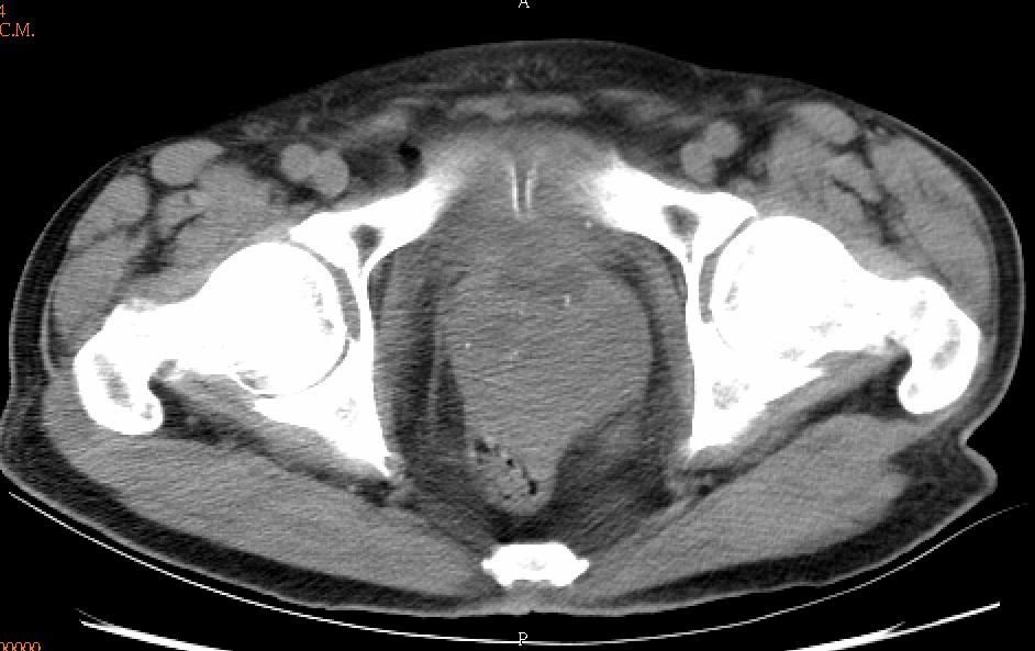 Imaging Abdominal and pelvic CT :