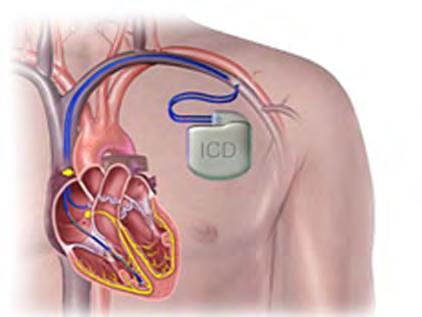 Transvenous ICD The transvenous ICD has been the practice standard for decades. In a transvenous system, the leads are inside the heart.