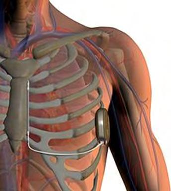 Subcutaneous ICD The subcutaneous ICD represents a novel approach to ICD therapy. In a subcutaneous system, the leads are placed under the skin overlying the rib cage above the heart.