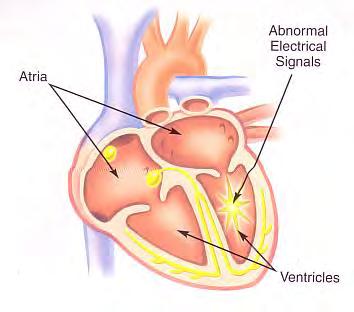 Ventricular Fibrillation (VF) In VF, the heart beat also starts at the bottom of the heart (ventricle) but is much faster, irregular, and chaotic when compared to VT.