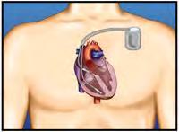 IMPLANTABLE CARDIOVERTER DEFIBRILLATOR Your heart doctor, who is a heart rhythm specialist, has decided that you need to have an Implantable Cardioverter Defibrillator (ICD). Why Do I Need an ICD?