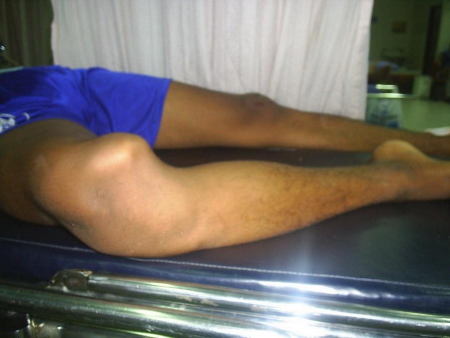 High-Energy Knee Dislocations Usually MVA or fall from a height Dashboard injury common Forced Hyperextension