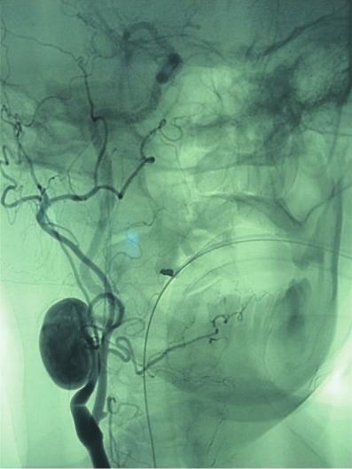 CT angiography confirmed a saccular aneurysm at the middle third of the extracranial internal carotid; larger diameter was 3 cm; no significant stenosis was detected.