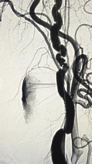 Angiography of the aortic arch and selective catheterization of its branches excluded significant stenosis and intracranial aneurysms.