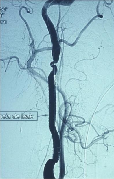 Case Reports in Surgery 3 (a) (b) (c) Figure 2: (a) Intraoperative angiography after second stent graft deployment, patent carotid, and leak absence; (b) one-year CT control, arrow points to the