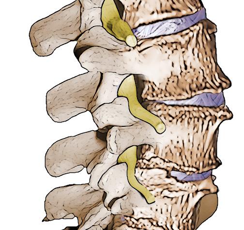 Degenerative Changes As the spine ages, discs lose some of the fluid that makes them spongy and soft