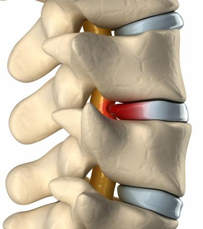 crack or tear in the tough outer layer. A herniated disc can irritate nerves causing pain, numbness or weakness in an arm or leg.
