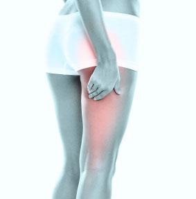 Piriformis Syndrome Underdiagnosed-Three Stooges Pain in buttock with possible intermittent radicular symptoms in posterior thigh to foot Increased pain with sitting for long time, specially on hard