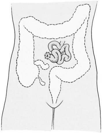 Inflammation of the vermiform appendix Lumen of the appendix becomes obstructed, the E.