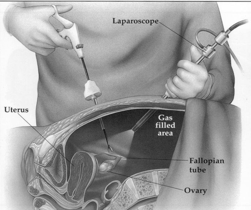 Ex-ray Ultrasound Laparoscopy Medical