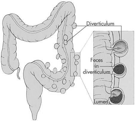 Disorders of the Intestines Diverticular disease Diverticulosis Pouch-like herniations through the muscular layer of the colon Slide 34 Figure 45-11 Diverticulosis.