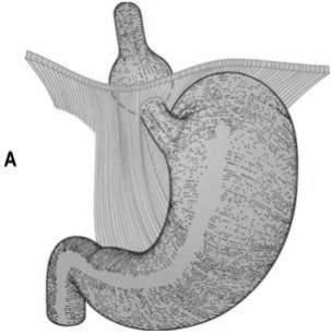 Figure 45-15 Hiatal hernia. A, Sliding hernia. B, Rolling hernia.