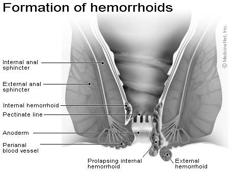 Hemorrhoids Varicosities (dilated veins) External or internal Contributing factors Straining with defecation, diarrhea, pregnancy, CHF, portal hypertension, prolonged sitting and standing Clinical