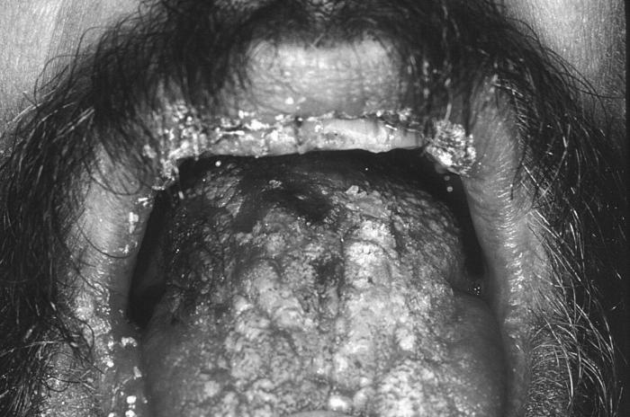Disorders of the Mouth Candidiasis Infection caused by Candida albicans Fungus normally present in the mouth, intestine,
