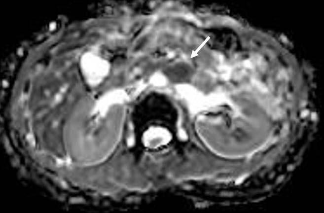 A metstti prorti lymph node in 59-yerold womn. An enlrged lymph node (rrow) with entrl neroti portion ws noted in the left pr-orti re.