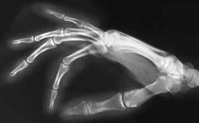 For example, you would have to fall from a great height or have a high-speed collision while skiing or skating. Your hand, including your wrist, is full of bones.