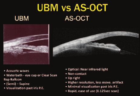 S P E C IA L S E C T I O N S P O N S O R E D B Y Q UA N T E L M E D I C A L Ultrasound Biomicroscopy & Glaucoma Care Visualizing angle closure and its mechanisms from screening to post-surgical