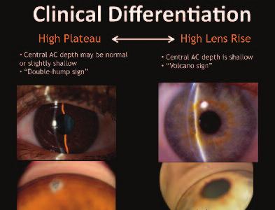 Figure 2. Differentiating high plateau from high lens rise. Emphasis on Angle Closure When I mention angle closure, colleagues often say, I don t think I see that very much.