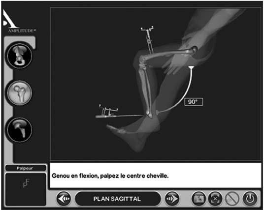Then the hip is dislocated and the bone morphing of the femoral head is performed using the pointer to determine not only the center of the pathologic femoral head but also the native femoral