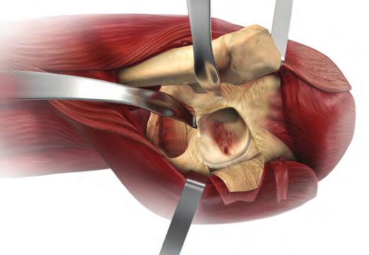 Posterior Capsulotomy Retract the short rotator muscles posteromedially together with the gluteus maximus (with consideration to the proximity of the sciatic nerve), thus exposing the posterior