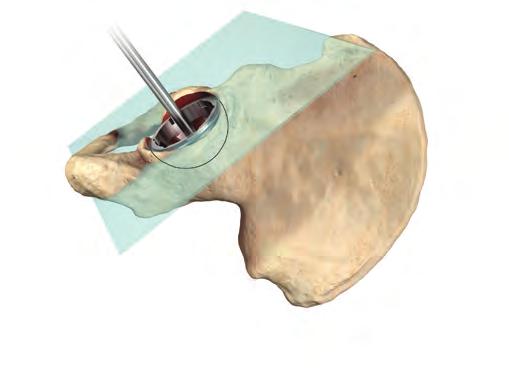 Acetabular shell trialing and positioning Determining Proper Anteversion The most reliable method for determining proper anteversion is the use of bony landmarks.