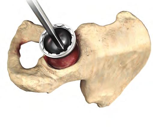 Securely thread the permanent acetabular shell prosthesis onto the acetabular cup positioner (Figure 23). Use the acetabular alignment guide to assist in component orientation.