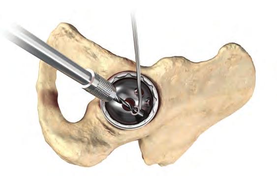notch to the center of the acetabulum (Figure 25).