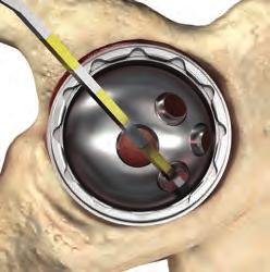 Implanting the Acetabular Shell with Screw Fixation Verify hole depth using the QUICKSET