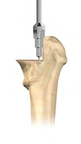 S-ROM Surgical Technique Step 1 Neck Osteotomy (90 degrees) Perform a preliminary resection of the femoral neck using the biomechanical femoral neck resection template as a guide.