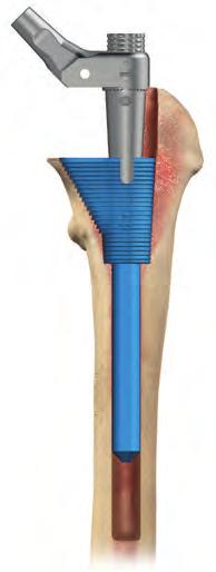 On the opposite side, the three proximal sleeve sizes are marked with the corresponding sleeve configuration. The location of each color band moves from distal to proximal as the size increases.