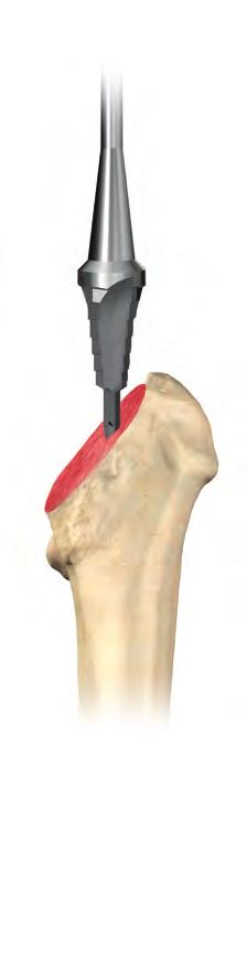 Mark the resection line using electrocautery or methylene blue.* Resect the femoral head. *Tip: Make a conservative neck resection initially and use the calcar planer to adjust.