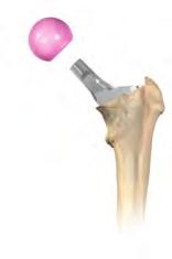 The following illustration depicts the position of the femoral component neck with relation to the opening of the acetabular